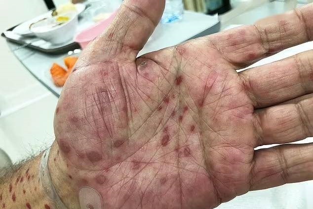 梅毒潜伏期多久 梅毒最长潜伏期多久