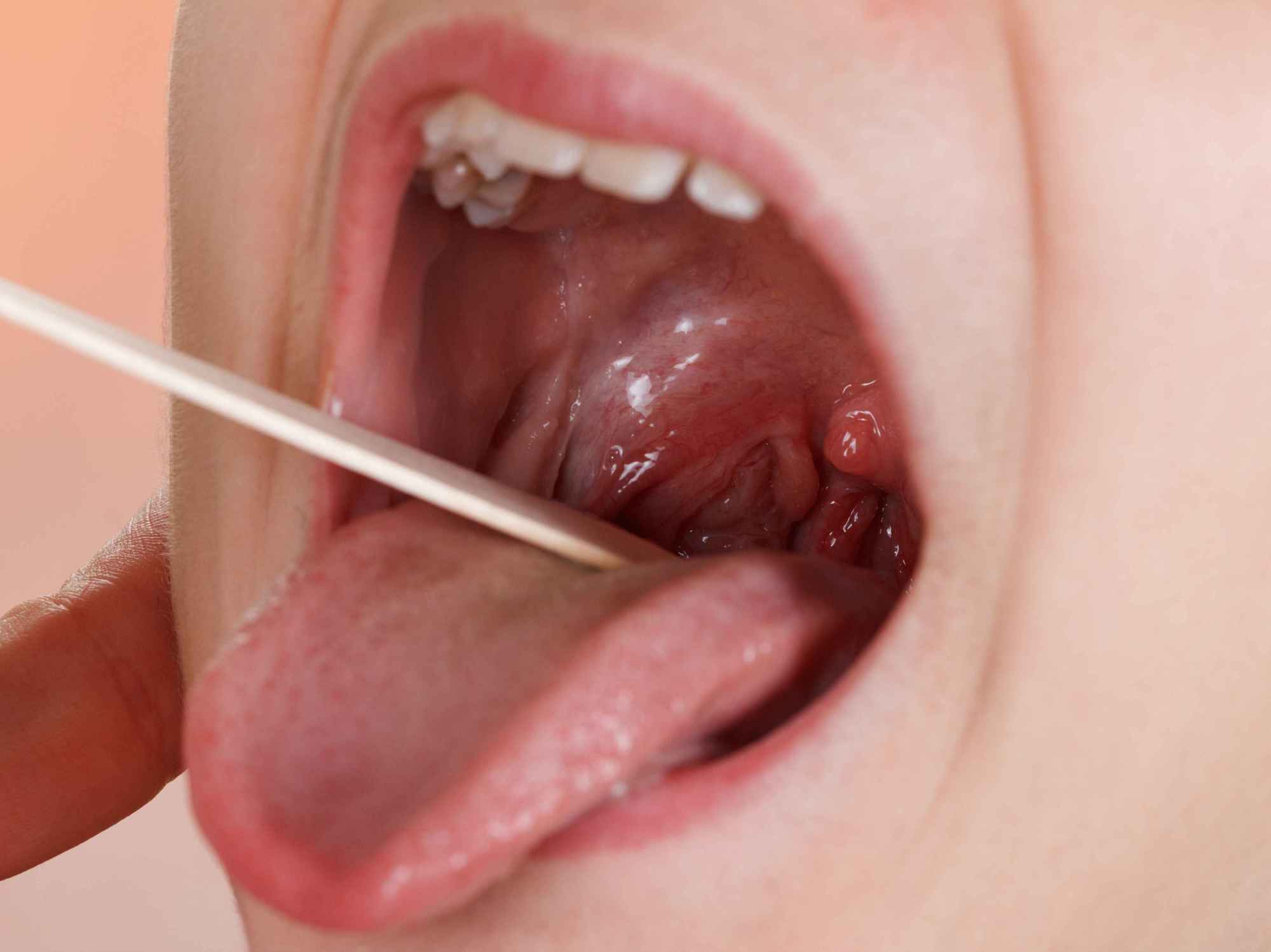扁桃体发炎忌吃什么