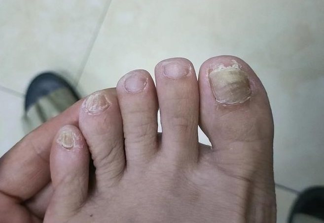 长灰指甲是什么原因
