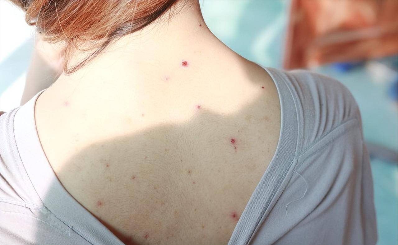 梅毒怎么传染的可以治愈么