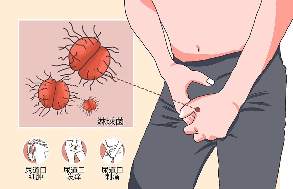 淋病是怎么感染上的男性