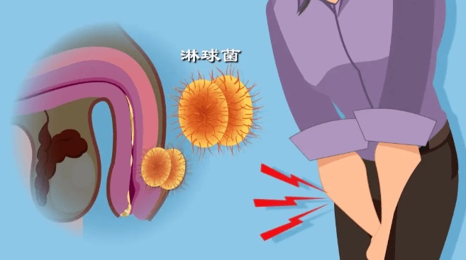 淋病怎么传染的几率高吗