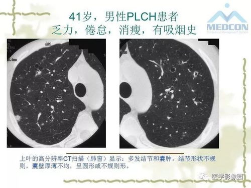 胃食管反流病要做胃镜吗 胃食管反流病要做胃镜吗