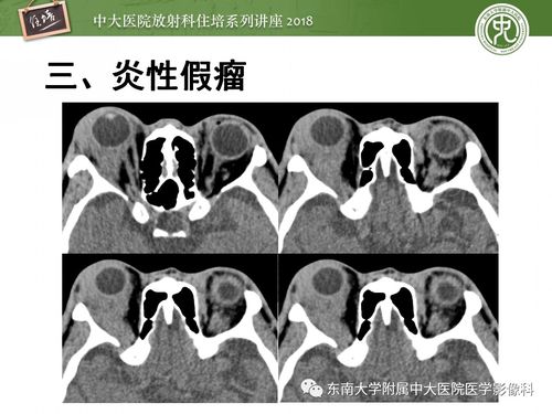 怎样治疗神经梅毒疗效果好 怎样治疗神经梅毒疗效果好