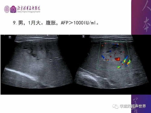 梅毒的五个特殊传播途径 梅毒的五个特殊传播途径