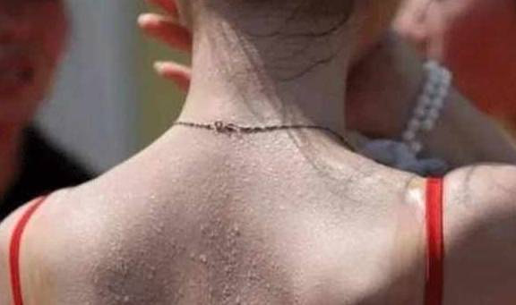 尿常规都正常会传染淋病 尿常规都正常会传染淋病