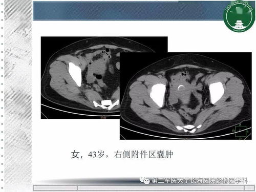 悬雍垂肿大是艾滋病吗 悬雍垂肿大是艾滋病吗