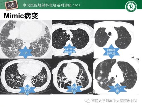 艾滋病病毒在昆虫体内 艾滋病病毒在昆虫体内