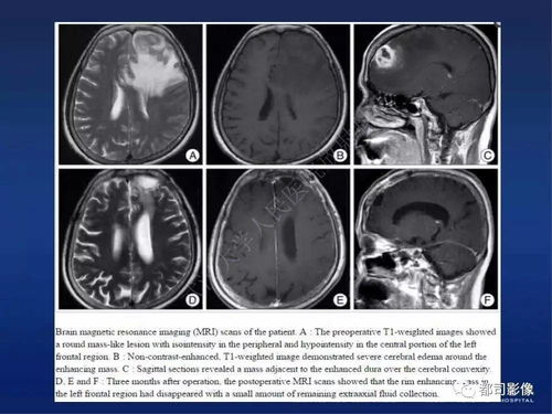 引起艾滋病的病因有哪些 引起艾滋病的病因有哪些