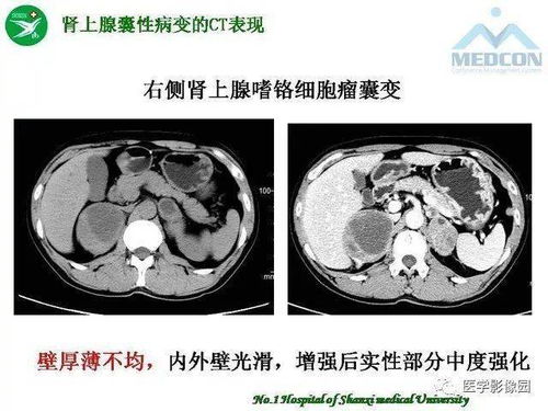 感染梅毒究竟有哪些危害 感染梅毒究竟有哪些危害
