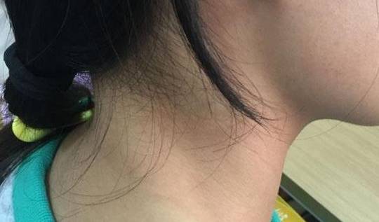 淋病抽血能不能查出来 淋病抽血能不能查出来
