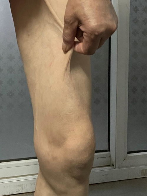 艾滋病哪种治疗方法好 艾滋病哪种治疗方法好