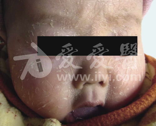 艾滋病有什么症状表现 艾滋病有什么症状表现