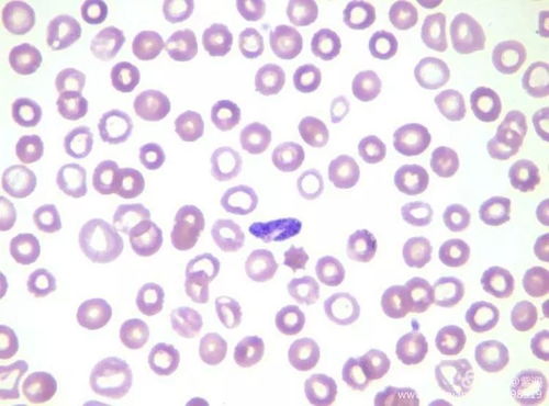 先天梅毒是什么样的 先天梅毒是什么样的