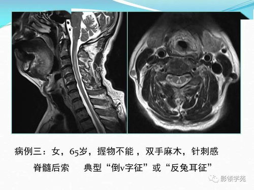女性得了艾滋病有什么症状出现 女性得了艾滋病有什么症状出现