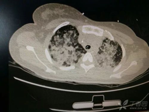 梅毒的潜伏期症状是什么 梅毒的潜伏期症状是什么