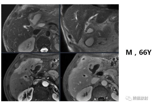 无症状的艾滋病是什么样 无症状的艾滋病是什么样