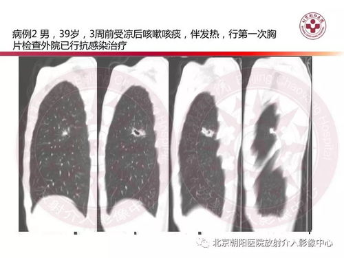 脂肪瘤图片及治疗方法(脂肪瘤图片) 脂肪瘤图片及治疗方法(脂肪瘤图片)