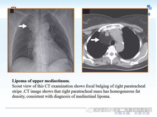 梅毒该如何正确诊断 梅毒该如何正确诊断