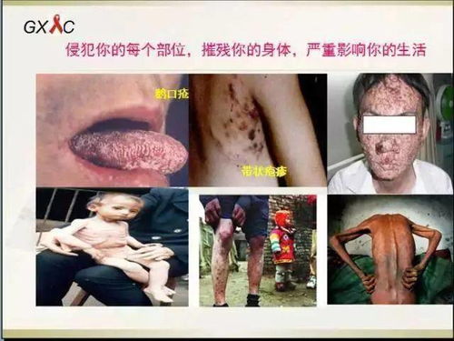 头皮屑猛增警惕患有梅毒 头皮屑猛增警惕患有梅毒