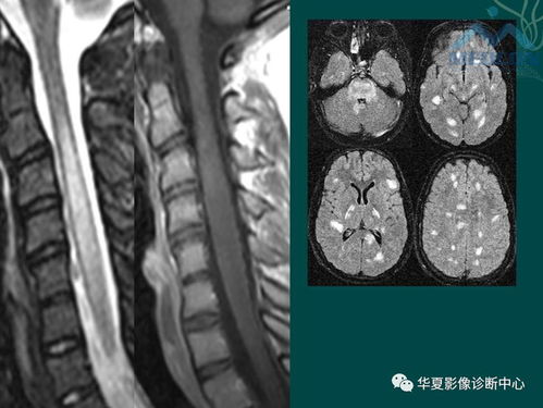 宝宝发烧查血常规能查出白血病吗 宝宝发烧查血常规能查出白血病吗