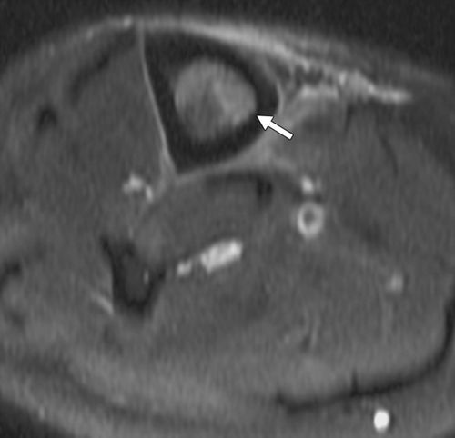 怎样预防梅毒发病 怎样预防梅毒发病