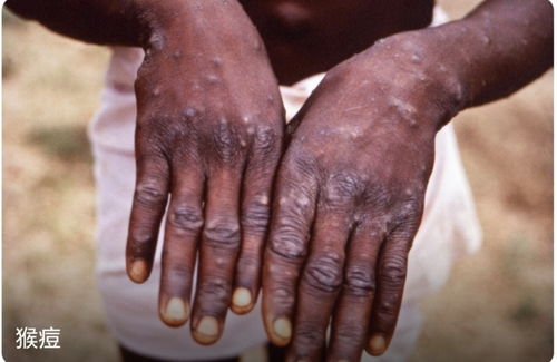 ע�� ���̲�����֢״�ױ�����Ϊ��ð 