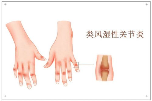 淋病常用药物有哪些药 淋病常用药物有哪些药