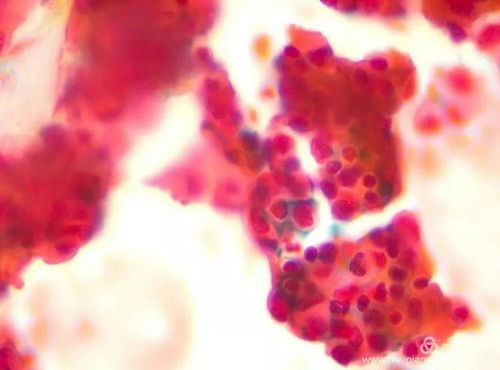 梅毒溃疡痒(梅毒长溃疡会疼怎么办) 梅毒溃疡痒(梅毒长溃疡会疼怎么办)