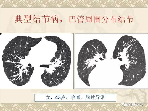 淋病最简单的医疗方法是什么 淋病最简单的医疗方法是什么