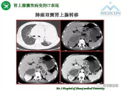 淋病和梅毒预防阻断药 淋病和梅毒预防阻断药