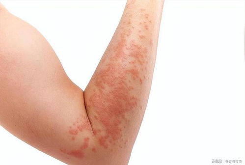 梅毒的护理方法是怎样的 梅毒的护理方法是怎样的