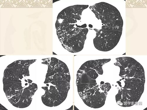 艾滋病对人们的危害有哪些 艾滋病对人们的危害有哪些