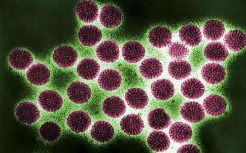 男性得艾滋病的人有什么症状 男性得艾滋病的人有什么症状