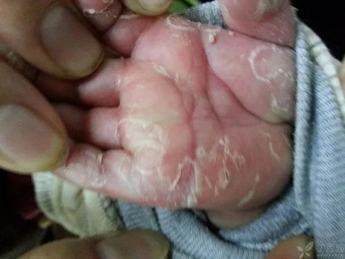 感染梅毒后潜伏期有多长时间 感染梅毒后潜伏期有多长时间