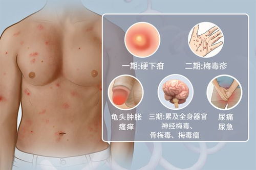 梅毒究竟跟什么有关 男性梅毒传染的根本原因介绍 梅毒究竟跟什么有关 男性梅毒传染的根本原因介绍