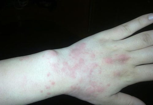 梅毒的方法是什么 梅毒的方法是什么