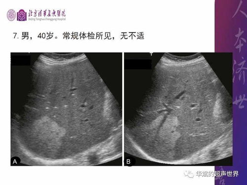 艾滋病人用具消毒法 艾滋病人用具消毒法