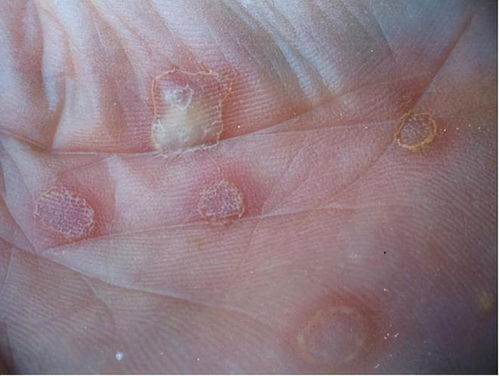 水杯装水会传染艾滋病吗 水杯装水会传染艾滋病吗