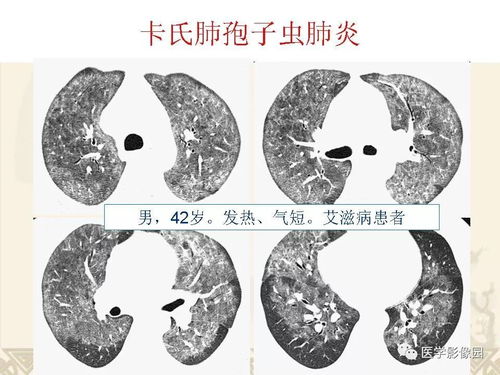 我国全球艾滋病基金项目将年底提前结束 我国全球艾滋病基金项目将年底提前结束