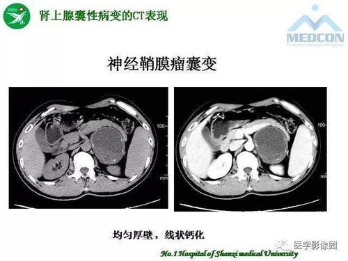 感染艾滋病多久出症状 感染艾滋病多久出症状