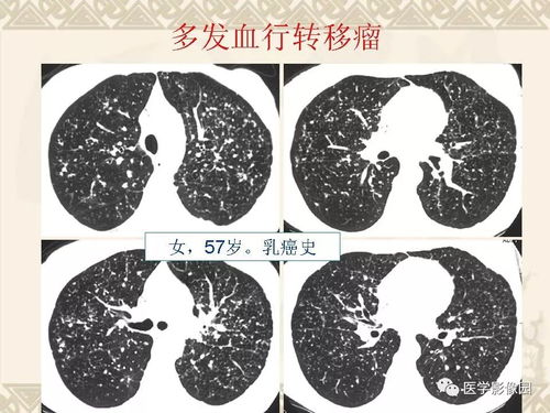 梅毒治疗的方法都有哪些呀 梅毒治疗的方法都有哪些呀