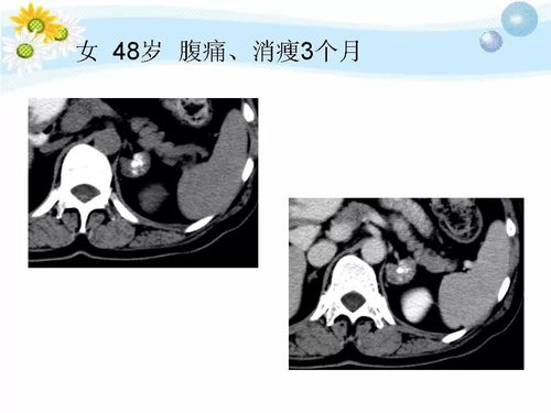 检查艾滋病不治疗会怎样 检查艾滋病不治疗会怎样
