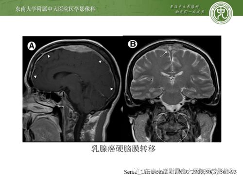 中国艾滋现状 32.1%感染者未被发现 艾滋病早期症状有哪些 中国艾滋现状 32.1%感染者未被发现 艾滋病早期症状有哪些