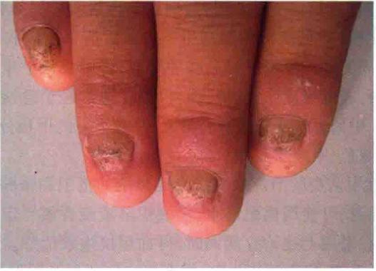 梅毒症状都有哪些呢 梅毒症状都有哪些呢