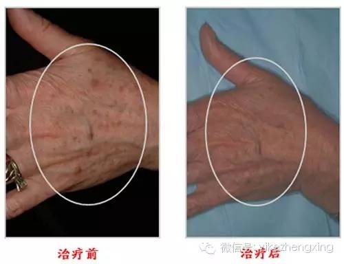 艾滋病潜伏期多久会发作 艾滋病发作有什么症状表现 艾滋病潜伏期多久会发作 艾滋病发作有什么症状表现