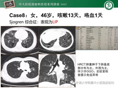 艾滋病的两个前期表现形式是哪些 艾滋病的两个前期表现形式是哪些