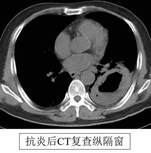 艾滋病初期什么样子 艾滋病初期什么样子