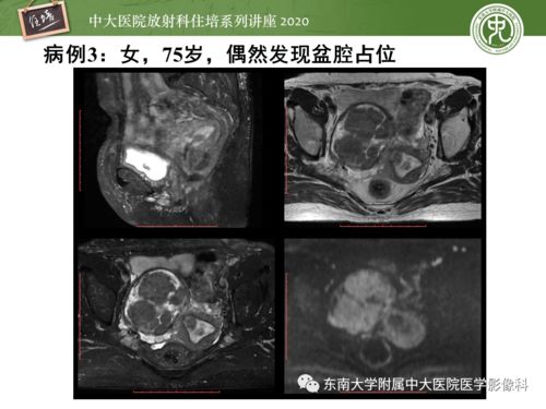 ����÷����֢״��ʲô ÷���ᵼ���ѷ��� 