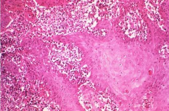 艾滋病症状初期时间多久 艾滋病症状初期时间多久